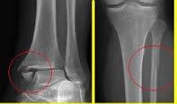 Maisonneuve Fracture Ø Spiral fracture of the proximal fibula with a tear of the syndesmosis Ø Associated