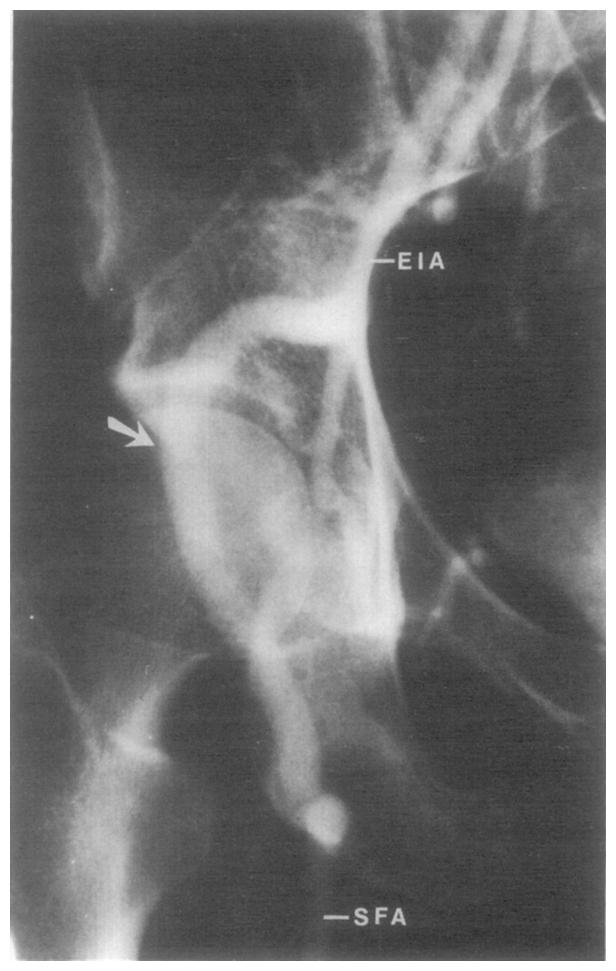 admission, he suffered a ruptured mycotic aneurysm of the right common femoral artery.