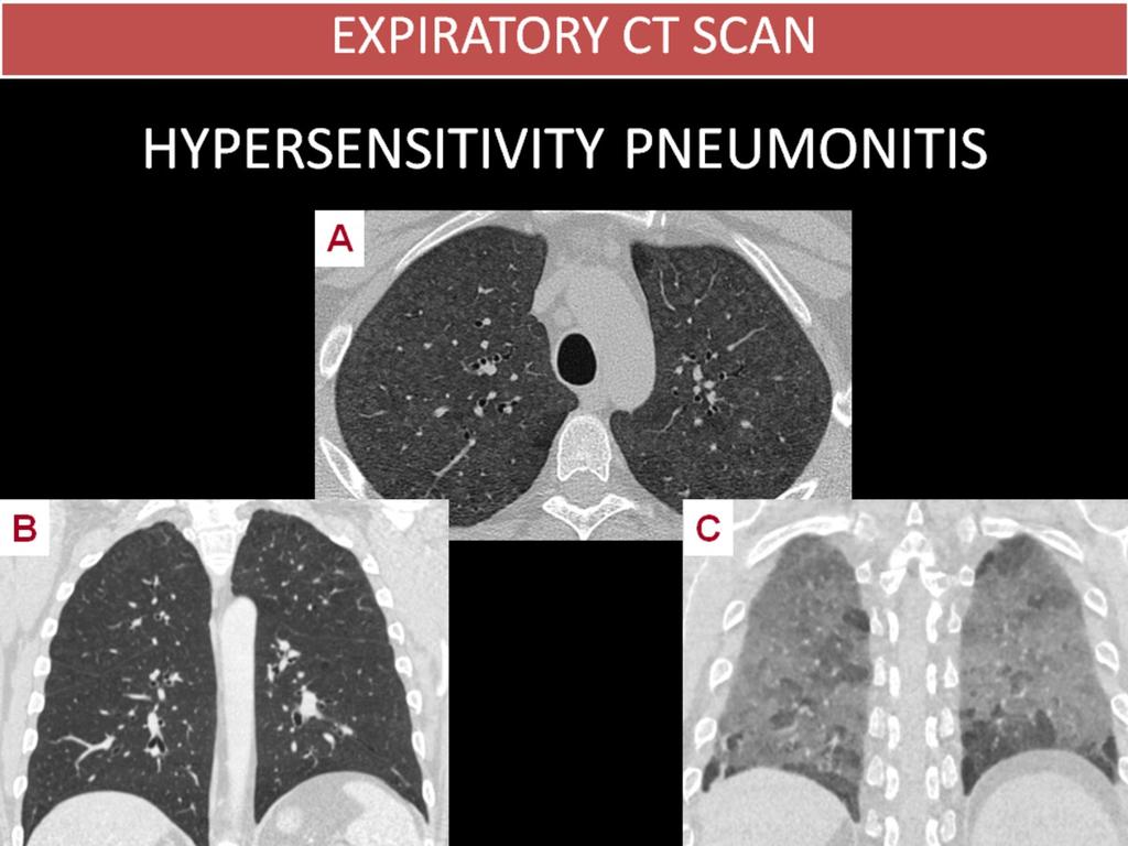 Fig. 6: HYPERSENSITIVITY PNEUMONITIS 48 year-old man working in a poultry slaughterhouse.