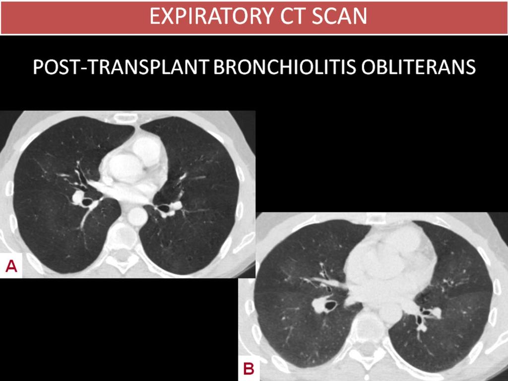 Fig. 7: POST-TRANSPLANT BRONCHIOLITIS OBLITERANS 30 year-old man with a history of acute lymphoblastic leukemia treated with hematopoietic progenitor cell transplantation and subsequent graft-vs-host