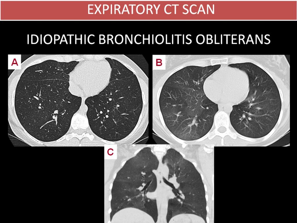 Fig. 8: IDIOPATHIC BRONCHIOLITIS OBLITERANS 31-year-old male nonsmoker with exertional dyspnea, who presented severe obstruction without hyperreactivity on pulmonary function tests.