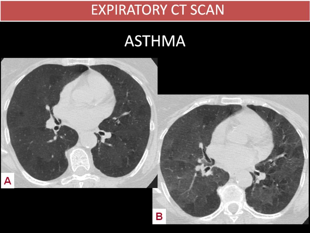 Fig. 10: ASTHMA 77 year-old woman with diagnosed asthma. She had clinical worsening with dyspnea to small efforts and images consistent with bronchiectasis on chest Xray. A. Inspiratory CT: Inhomogeneous pattern of the lung parenchyma with hypodense and hyperdense patchy areas of geographic borders.