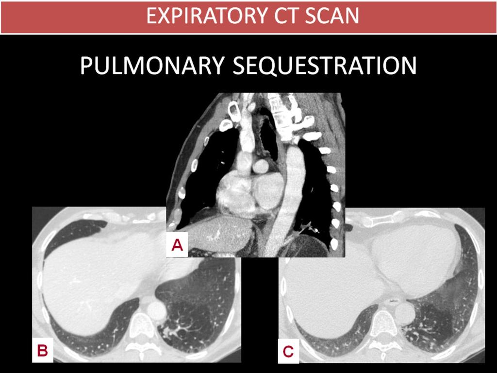 Fig. 11: PULMONARY SEQUESTRATION Incidental finding of pulmonary sequestration on chest CT.