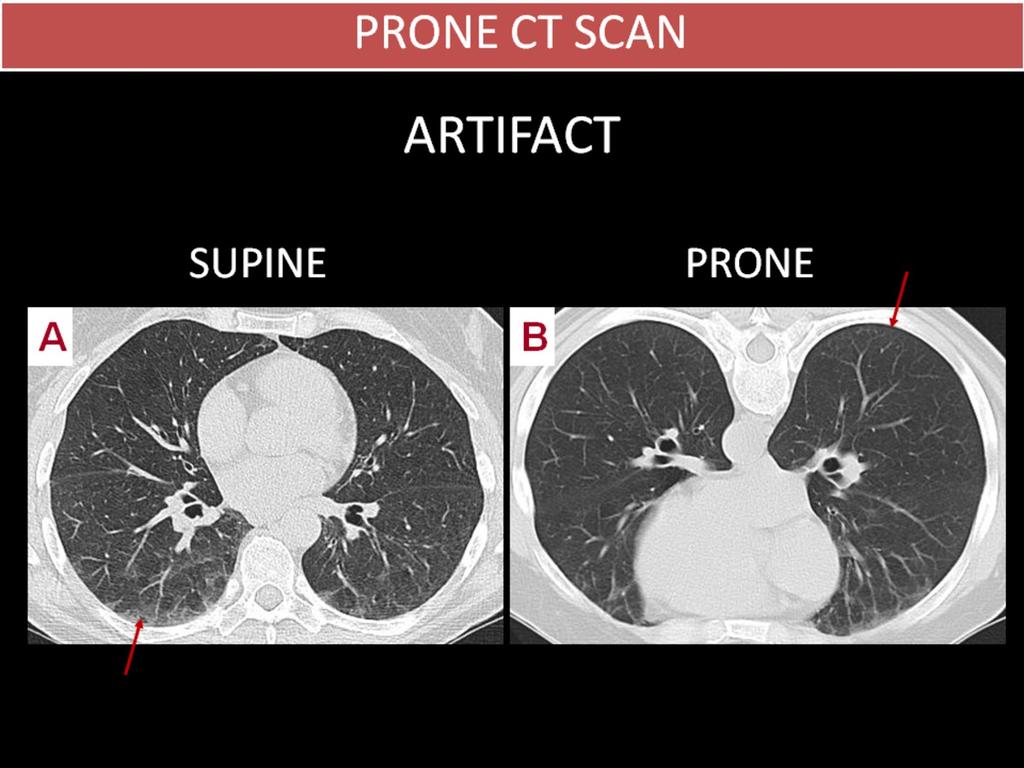 Fig. 13: ARTIFACT Chest CT perfomed on a 54 year-old woman for evaluation of a nodule identified on preoperative chest radiography.