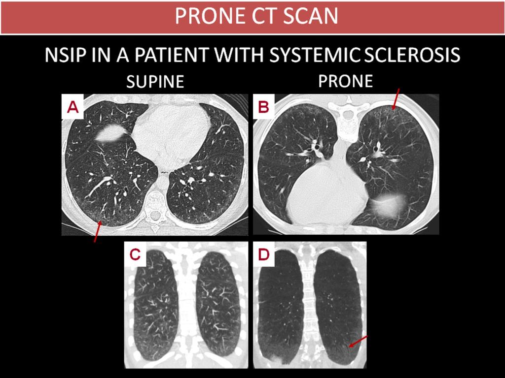 Fig. 14: NSIP IN A PATIENT WITH SYSTEMIC SCLEROSIS 36 year-old woman with diffuse systemic sclerosis and pulmonary function tests within normal limits.