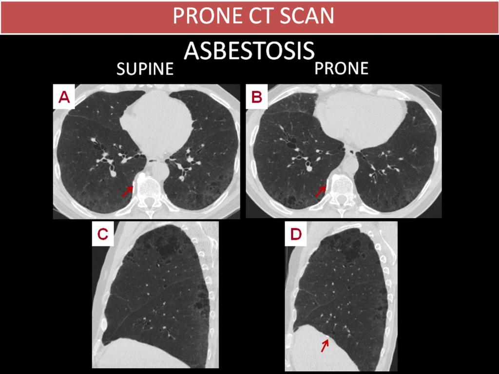 Fig. 16: ASBESTOSIS 62 year-old male asbestos worker. Subpleural ground-glass opacities, predominantly in the lower lobes (A, C), which persist in the prone position (B, D).