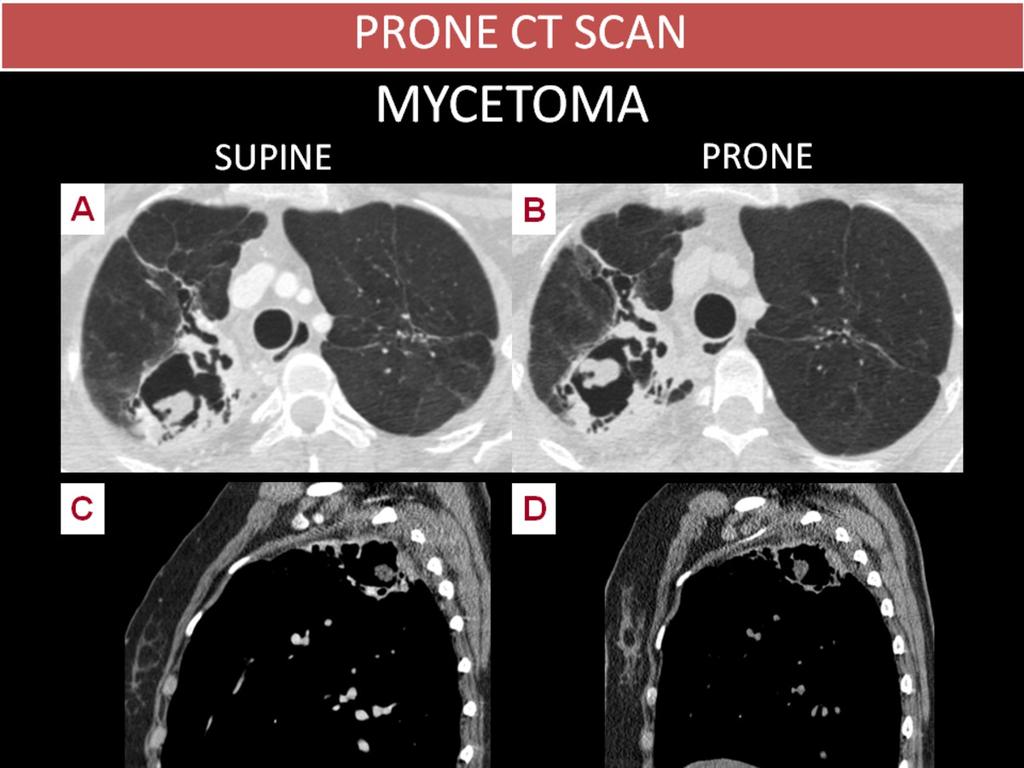 Fig. 17: MYCETOMA 26 year-old female with a prior history of tuberculosis successfully treated at 18 years old, with residual right apical cavity and images of bronchiectasis.