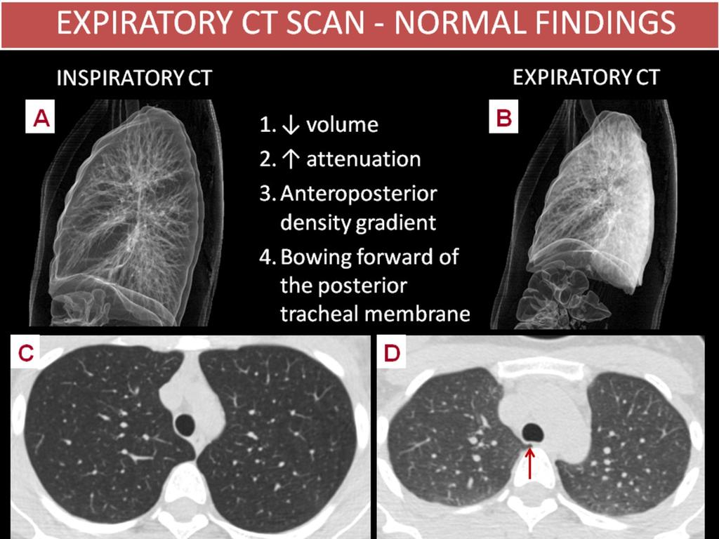 Images for this section: Fig. 1: NORMAL FINDINGS ON EXPIRATORY CT SCAN Inspiratory axial CT scan shows the normal round shape of the trachea (C).