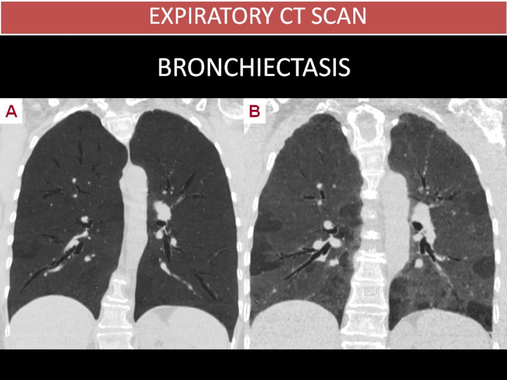 Fig. 2: BRONCHIECTASIS 51 year-old woman, ex-smoker, with wheezing.