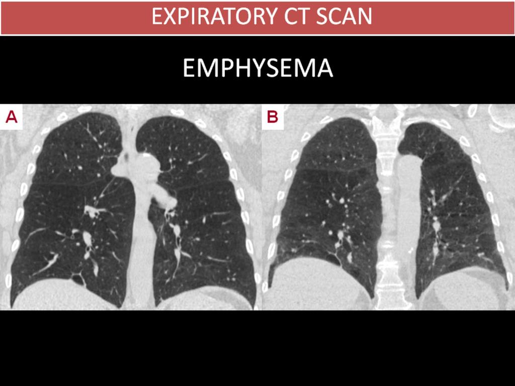 Fig. 3: EMPHYSEMA 60 year-old woman, ex-smoker, with COPD and severe obstructive pattern on spirometry who requires home oxygen therapy. A.