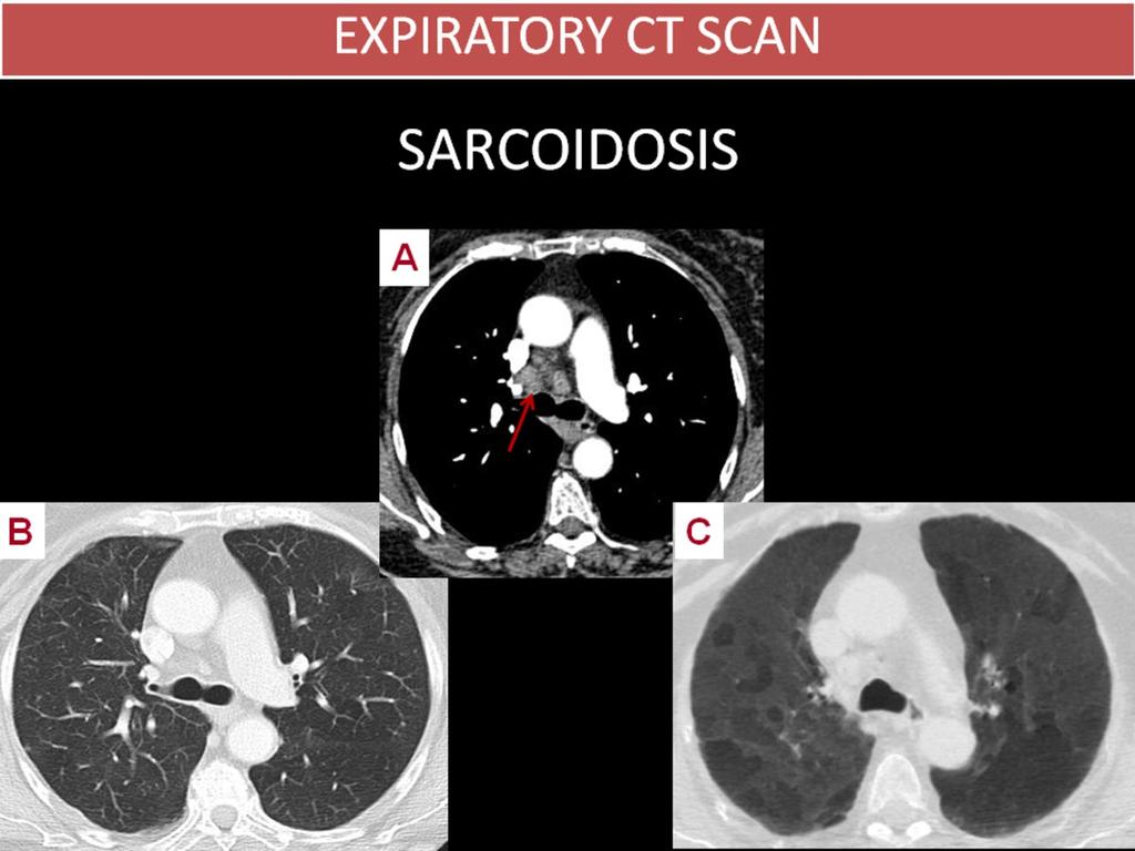 Fig. 4: SARCOIDOSIS 78 year-old woman with odynophagia and mediastinal widening on chest radiography caused by lymphadenopathies.