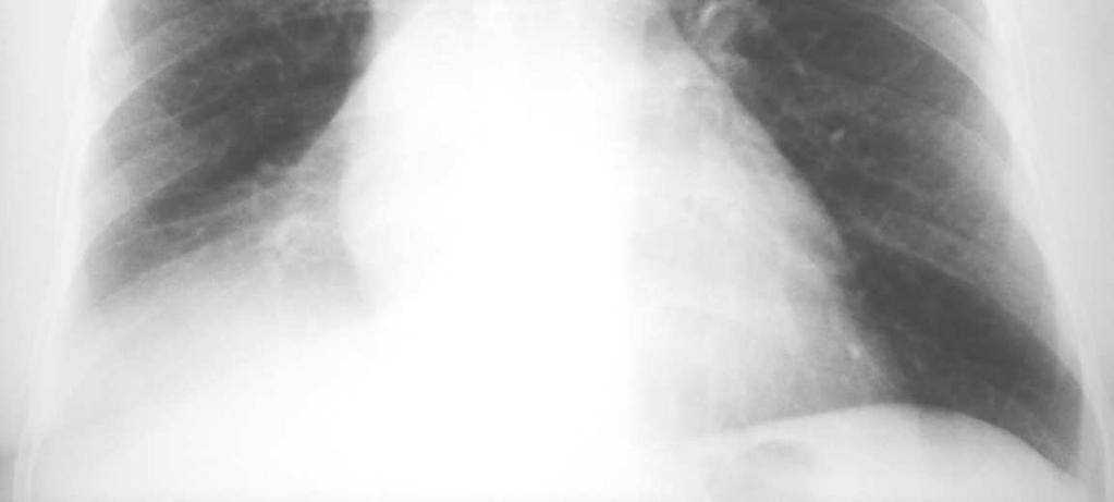 lung. Atelectasis is often associated with abnormal displacement of fissures, bronchi,