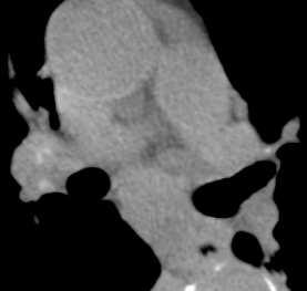 Mediastinal and hilar lymph nodes range in size from sub-ct resolution to 12 mm.