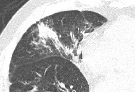 Consolidation Pathology. Consolidation refers to an exudate or other product of disease that replaces alveolar air, rendering the lung solid (as in infective pneumonia). CT scans.