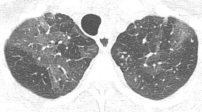 Ground-glass opacity On CT scans, it appears as hazy increased opacity of lung, with preservation of bronchial and vascular margins.