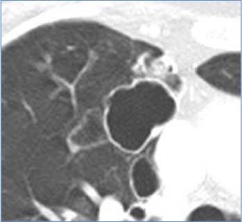 low-attenuating area with a well-defined interface with normal lung.