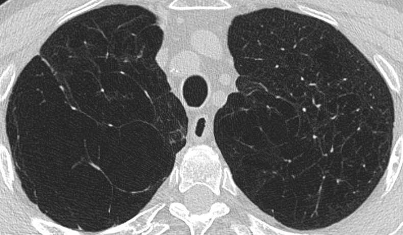 Emphysema Pathology. Emphysema is characterized by permanently enlarged airspaces distal to the terminal bronchiole with destruction of alveolar walls.