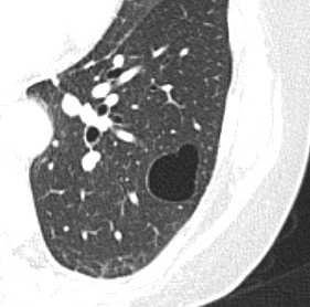 Bulla Pathology. An airspace measuring more than 1 cm usually several centimeters in diameter, sharply demarcated by a thin wall that is no greater than 1 mm in thickness.