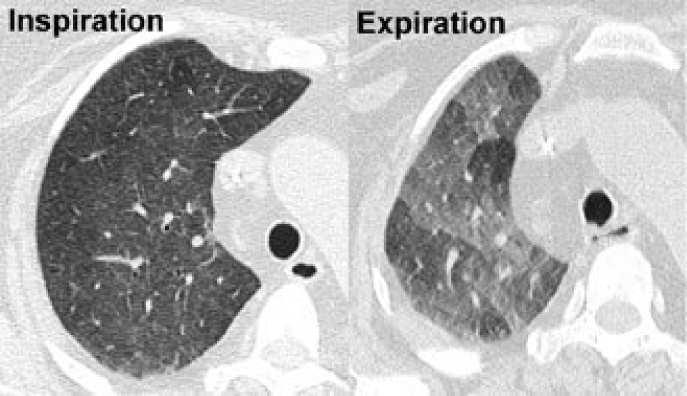 Air trapping Pathophysiology. Air trapping is retention of air in the lung distal to an obstruction (usually partial). CT scans.