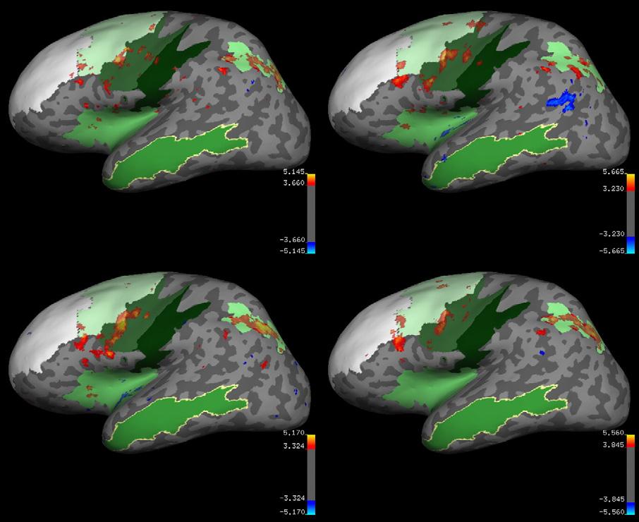 A. Yendiki et al. / NeuroImage 53 (2010) 119 131 129 Fig. 9. Top 2% of Z-values for contrast of highest versus lowest memory load, shown for each of the 4 sites.