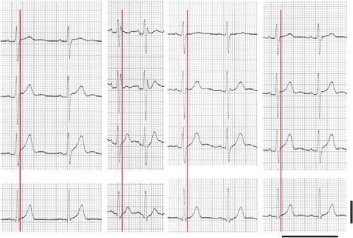 Brugada patient showing saddle-back type ST-segment (lead V 2 ) at baseline, ST-segment amplitude slightly decreased at peak, but reascended at early recovery (3 min), resulting in typical coved-type