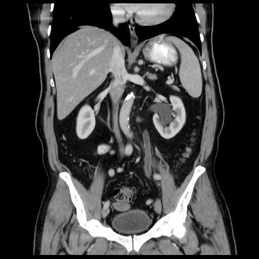THE CASE A 62-year-old male presented with history of burning micturition, sense of incomplete emptying of bladder, hematuria, urgency, with urge incontinence and nocturia of 4-5 times per night.