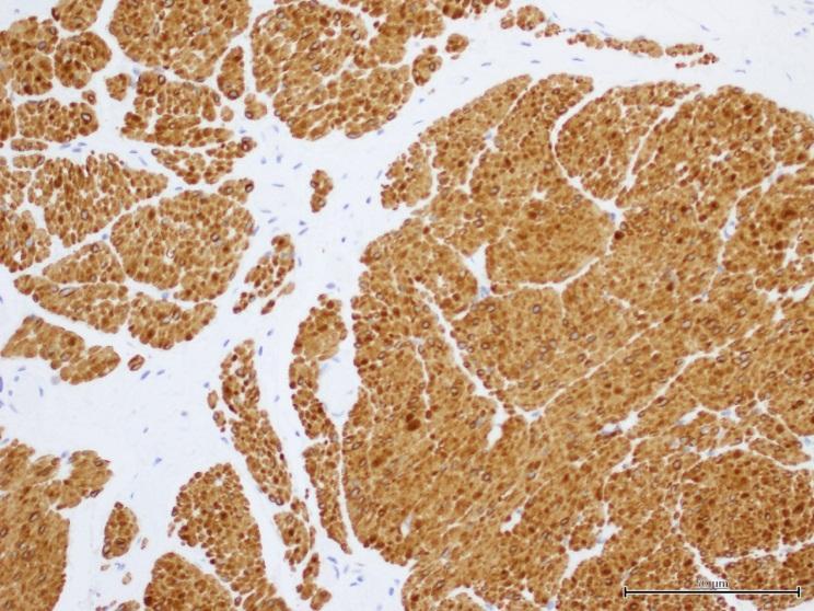 The appearances suggested a cavernous type of angioleiomyoma. Immunohistochemical stains for smooth muscle actin and desmin (smooth muscle markers) were positive, see figure 3.
