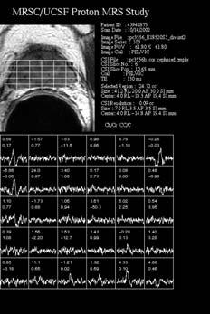 Pre-Salvage MRSI Imaging & CT Post Brachytherapy
