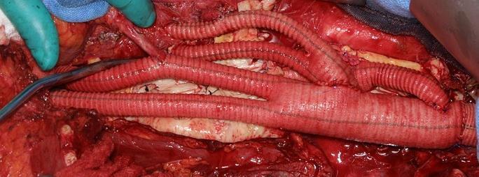 Complex Aortic Aneurysm Repair Aortic aneurysms were the primary cause of 10,597