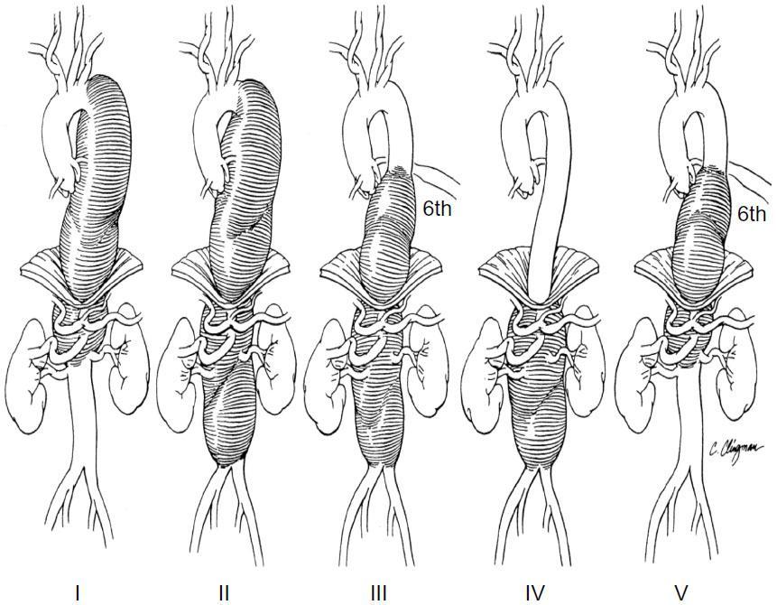 Thoracoabdominal aortic aneurysm These are aortic aneurysms can span the chest and the abdomen These aneurysm are classified in 5 categories Extent I from left subclavian to above the renal artery
