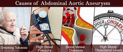 Abdominal aortic aneurysm Male to female ration 4:1until 80 then it becomes 1:1 More common in white males accordingly to a