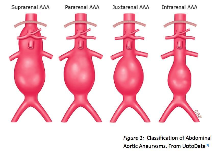 Abdominal aortic aneurysm There are different classifications of abdominal aneurysm Suprarenal extends above the renal arteries Pararenal is right at the