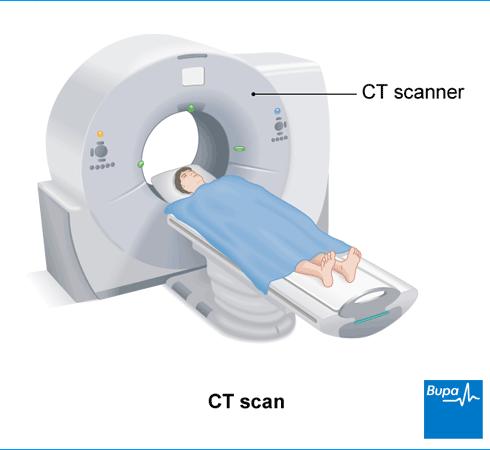 DIAGNOSIS CT scan Use to be the gold standard for evaluating the aorta with sensitivities and specificities >95% - Can get an exact measurement of the aneurysm diameter - Determine the extent of the