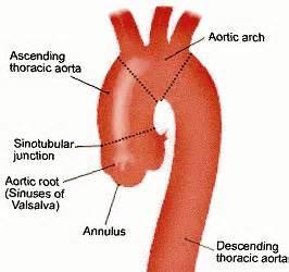THORACIC AORTIC The aorta is divided into two main segments thoracic and abdominal.