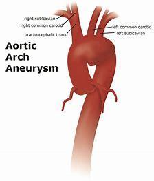 ARCH AORTIC ANEURYSM The aortic arch is the segment of aorta between the innominate artery and subclavian artery.