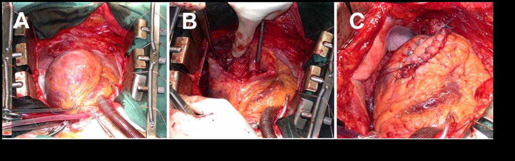 Surgical Therapy for ES Resection of aneurysm and cryodestruction of arrhythmogenic