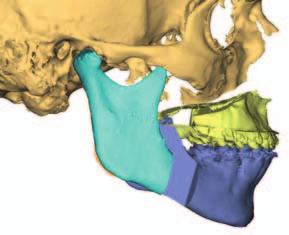 Orthognathic surgery Preoperative planning for virtual simulation of maxillary/mandibulary osteotomies,