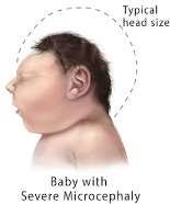 Zika virus infection during pregnancy is one of several causes for microcephaly and other