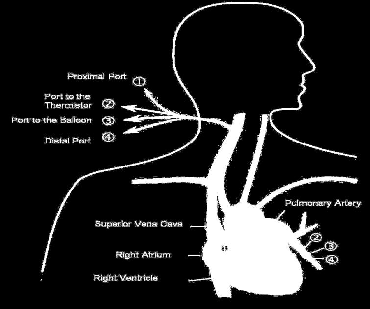 Central Venous Pressure Pulmonary Artery Pressure (Balloon Deflated) Pulmonary Artery
