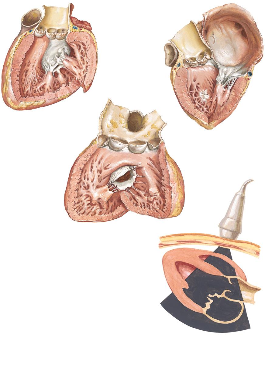 Figure 29-1 Mitral Stenosis Mitral stenosis, viewed from below and left: Minor rheumatic involvement of aortic valve Enlargement of R.