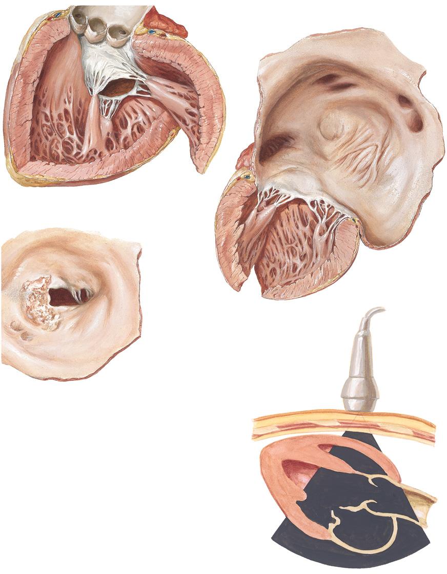 Figure 29-3 Mitral Regurgitation Mitral insufficiency: Mitral valve viewed from below; marked shortening of posterior cusp, with only slight commissural fusion, and little fusion and shortening of