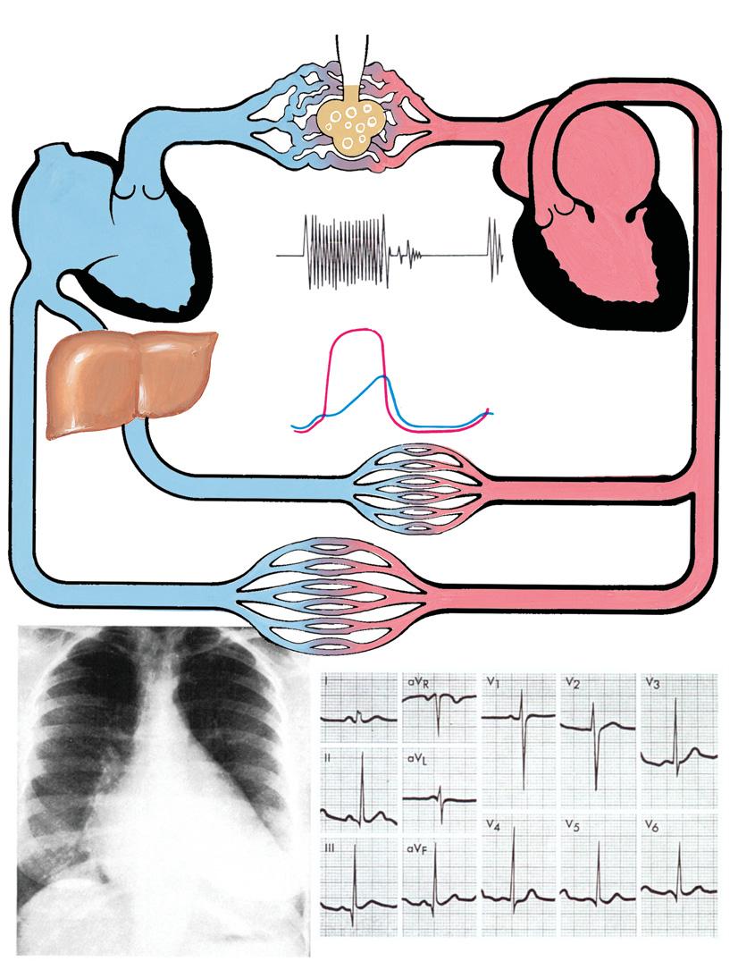 Figure 29-4 Pathophysiology and Clinical Aspects of Mitral Regurgitation Elevated wedge pressure Elevated pulm.