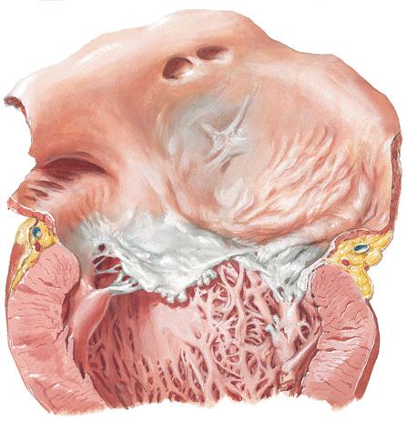 erosion of mitral valve with stumps of ruptured chordae tendineae resulting in valvular