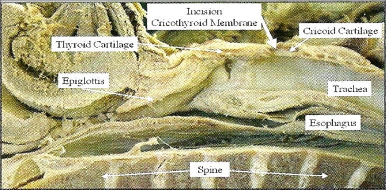 Anatomy CTM 9 (5-12) x 24 (22-30) mm Medial ligament (9mm) Lateral