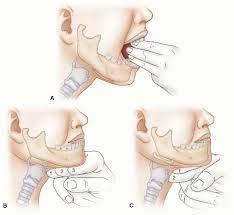 3-3-2 Rule To assess patient: 3 fingers between teeth.