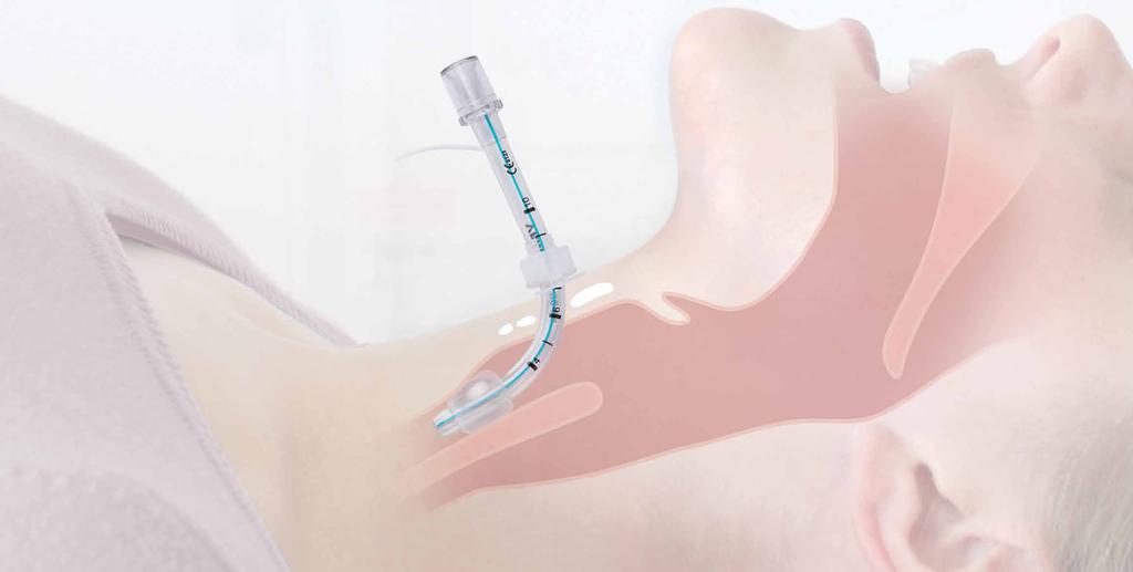 Cricothyrotomy Set Surgicric Cricothyrotomy is a life-saving technique and is only used as a last resort for patients in cannot