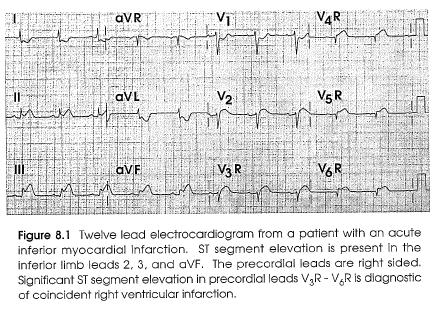 Right Ventricular Infarction RV infarction is almost always complicated by inferior LV infarction since the right coronary artery usually also supplies the inferior (diaphragmatic) wall of the left