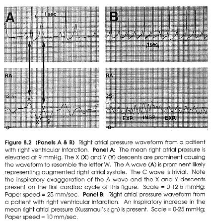Right Ventricular Infarction RA pressure is elevated to 10 mm Hg or greater. The X and Y descents are prominent.