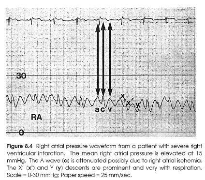 Right Ventricular Infarction RA systolic dysfunction may complicate RV infarction, especially when the coronary artery occlusion is proximal and compromises RA blood supply.