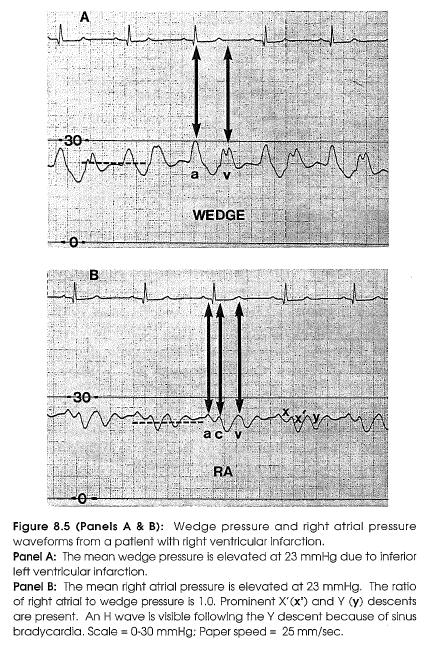 Right Ventricular Infarction Wedge pressure is usually elevated because of concomitant inferior-septal left ventricular infarction.